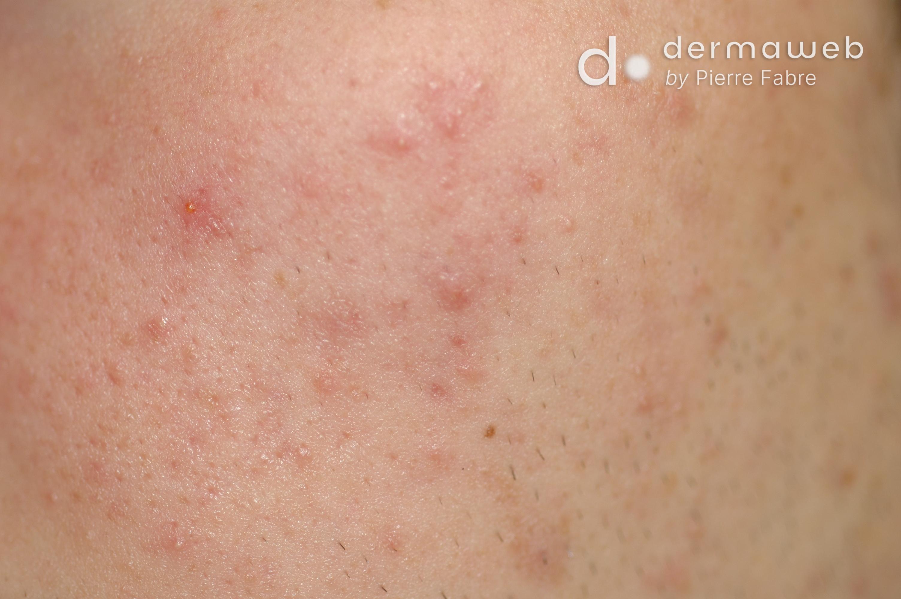 Acnelittekens: Post-inflammatoire erythemen